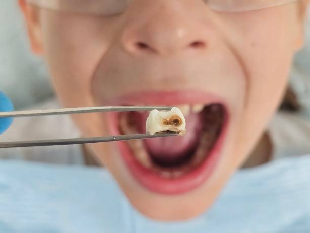 Best Knocked-Out Tooth Emergency  in Hebron, OH